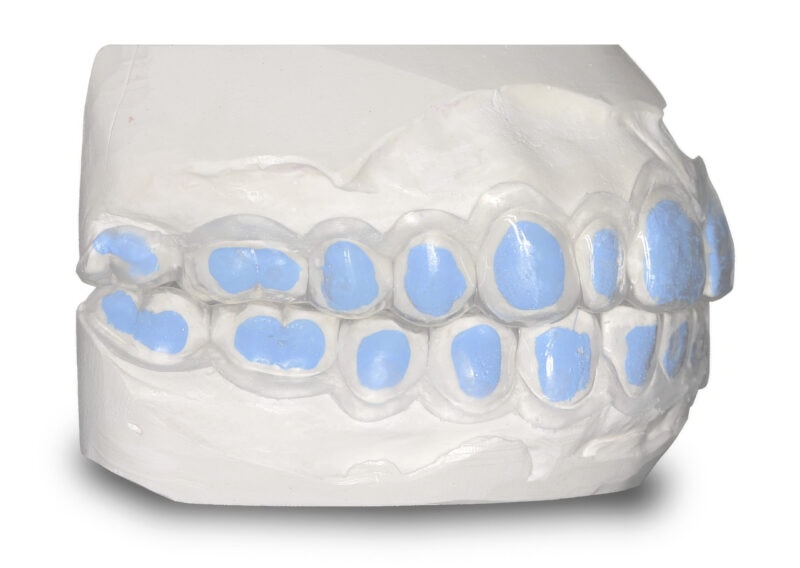 Bleaching tray with reservoirs – Perfect fit for uniform whitening and effective fluoridation