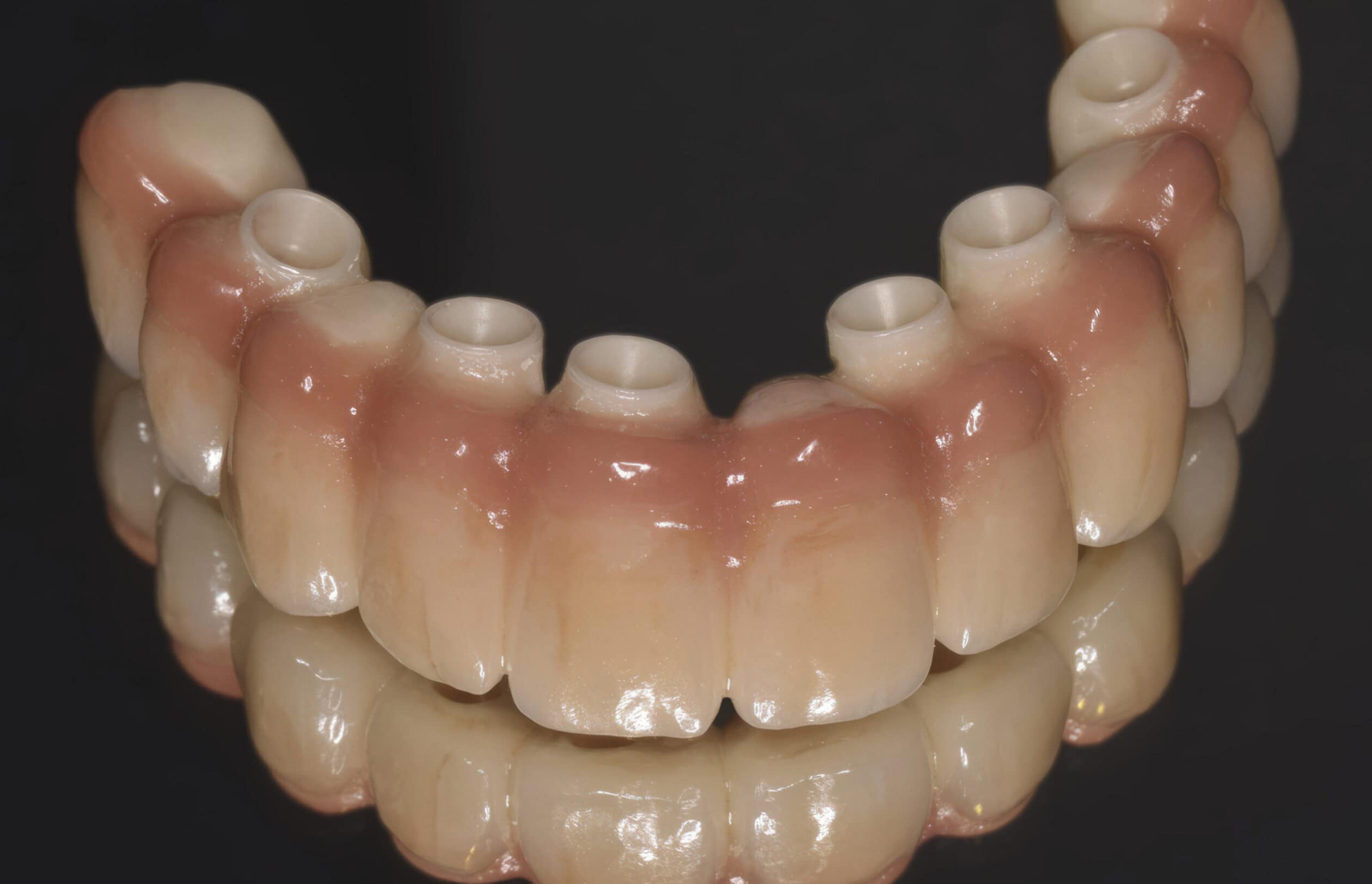 CAD/CAM resin implant bar with gingival mask – Implant-retained prosthesis