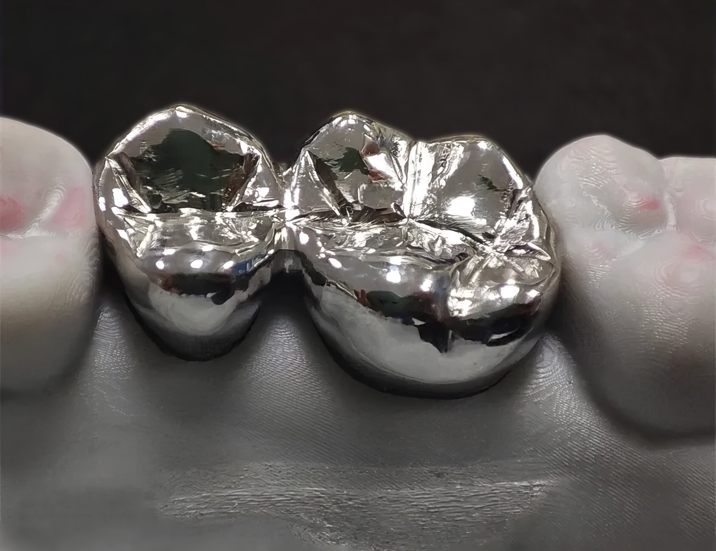 Cast Crown – Cost-Effective, Durable Fixed Dental Prosthesis for Long-Lasting Restoration of Damaged Teeth