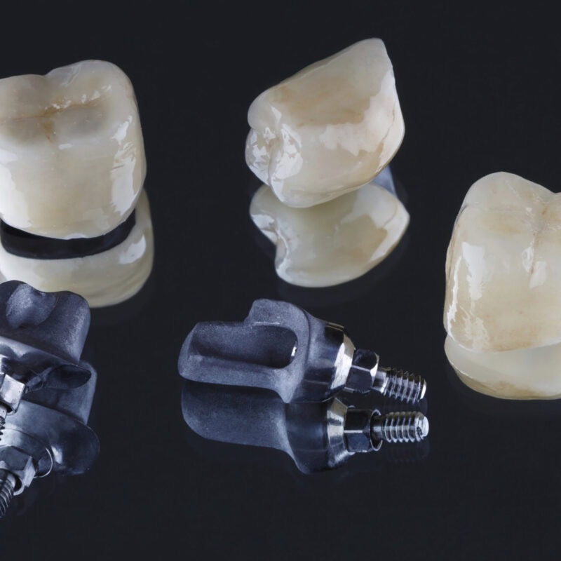 Cemented dental crowns and custom implant abutments – precise fit and natural design