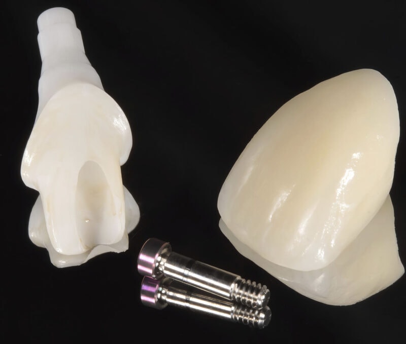 Cemented implant crown with titanium abutment – aesthetic single-unit restoration