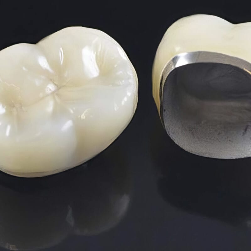 Ceramo-metallic crown (CMC) – Fixed dental prosthesis combining strength and aesthetics for durable restorations