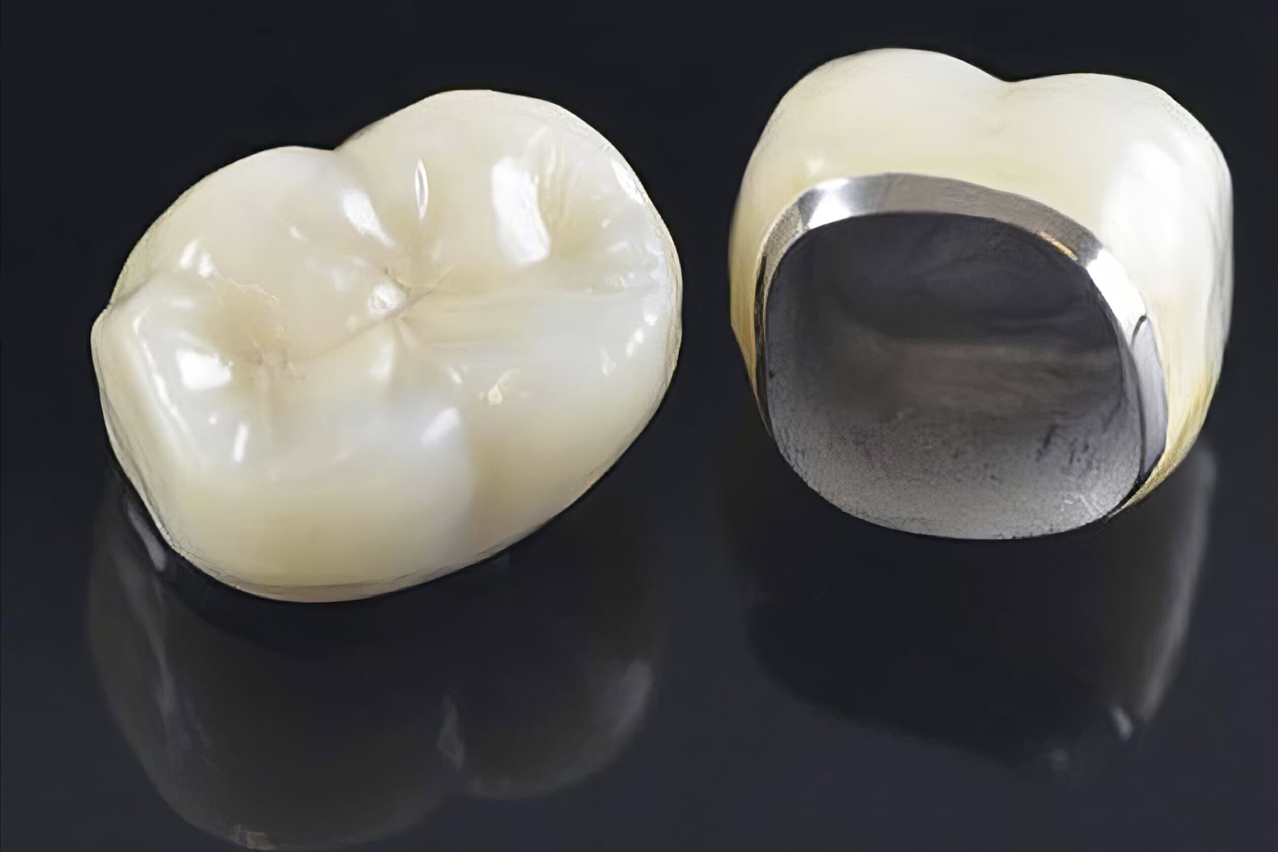 Ceramo-metallic crown (CMC) – Fixed dental prosthesis combining strength and aesthetics for durable restorations