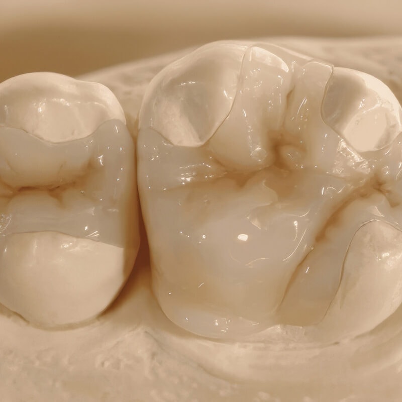 Composite Inlay Onlay – Aesthetic and Durable Solution for Restoring Teeth, a Modern Alternative to Traditional Fillings 2