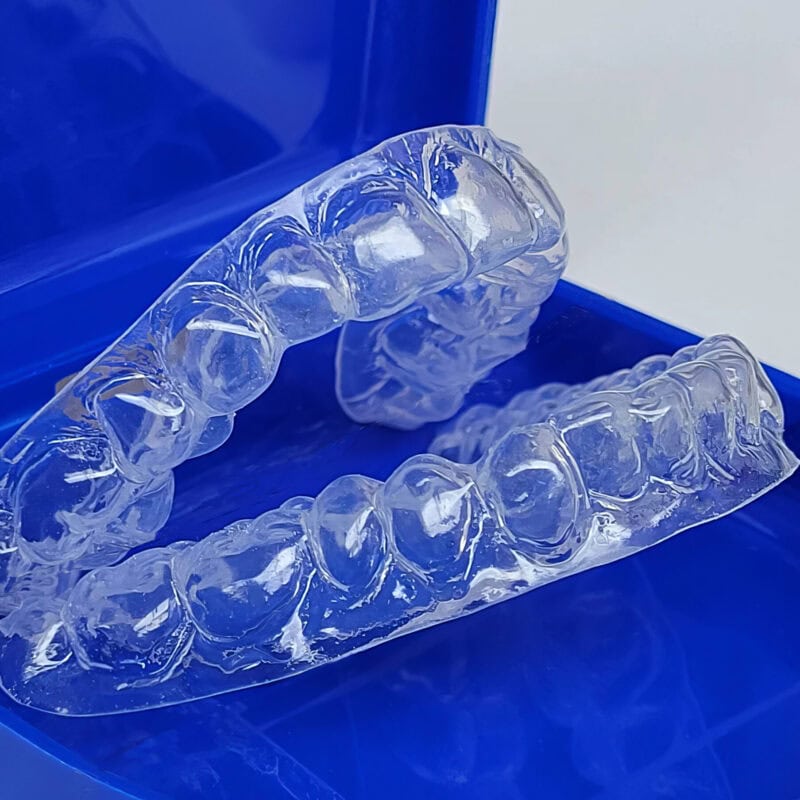 Custom bleaching tray – Effective whitening and fluoridation to strengthen enamel and enhance dental aesthetics