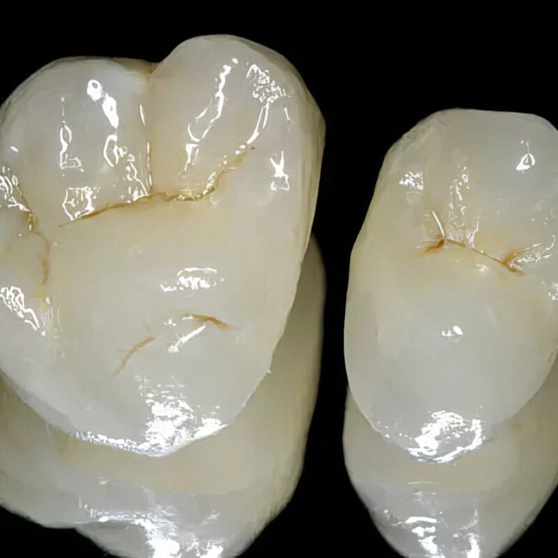 E-max : Empress Crown – Premium 100% Ceramic Dental Prosthesis for an Aesthetic and Long-Lasting Restoration 2