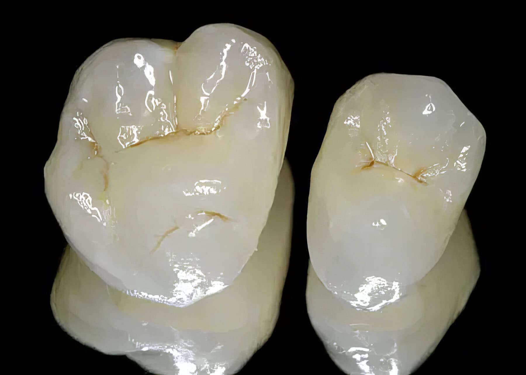 E-max : Empress Crown – Premium 100% Ceramic Dental Prosthesis for an Aesthetic and Long-Lasting Restoration 2