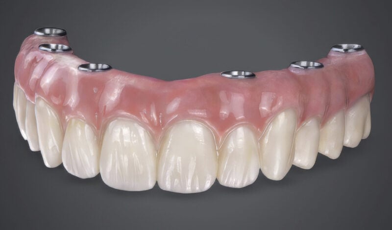 Example of All-On restoration with pink gingival base and high-quality resin teeth
