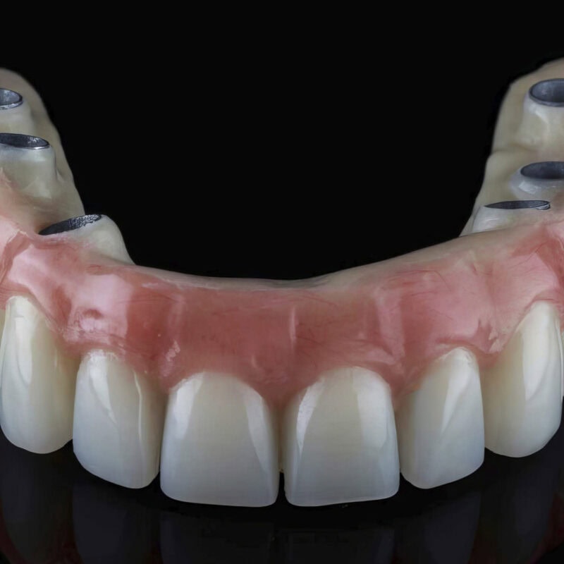 Full All-On prosthesis on implants with titanium framework and acrylic cosmetic layer