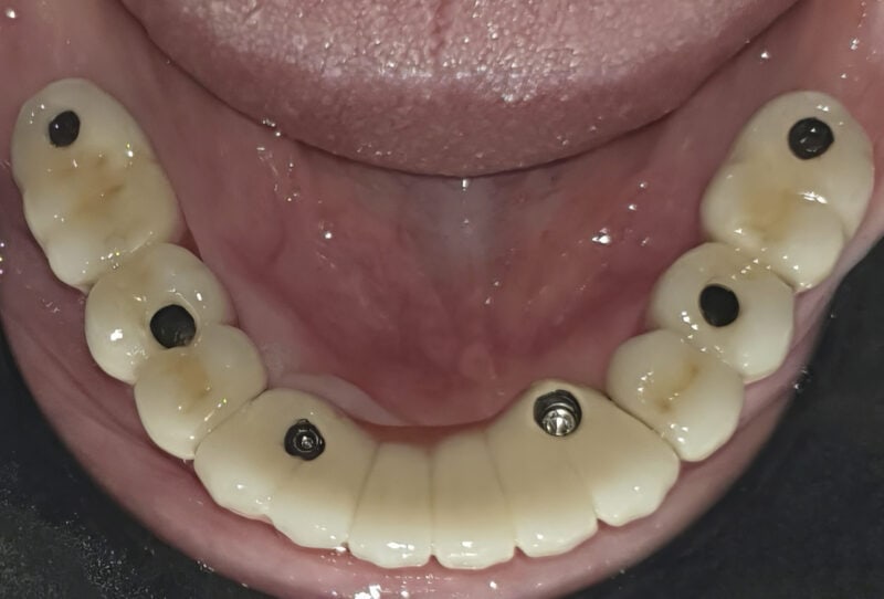 Full screw-retained bridge on multi-unit implants – visible occlusal access for easy screwing:unscrewing