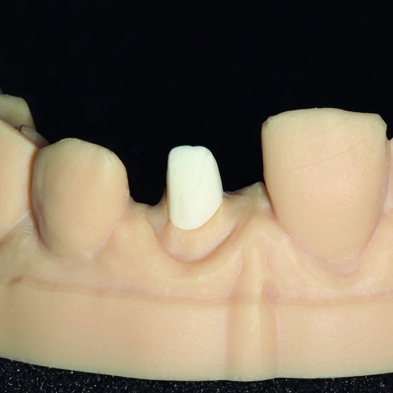 Glass Fiber Inlay-Core – Innovative Solution for a Strong, Aesthetic and Biocompatible Dental Restoration 2