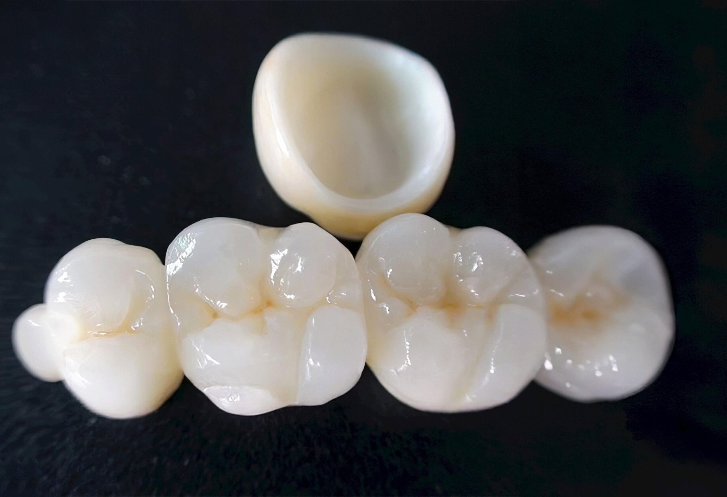 Layered Zirconia Crown – Premium Dental Prosthesis Combining a Zirconia Framework and Ceramic Layering for a Natural and Long-Lasting Result 2
