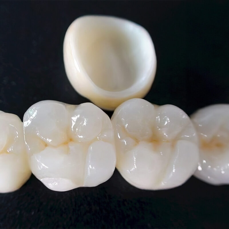 Layered Zirconia Crown – Premium Dental Prosthesis Combining a Zirconia Framework and Ceramic Layering for a Natural and Long-Lasting Result 2