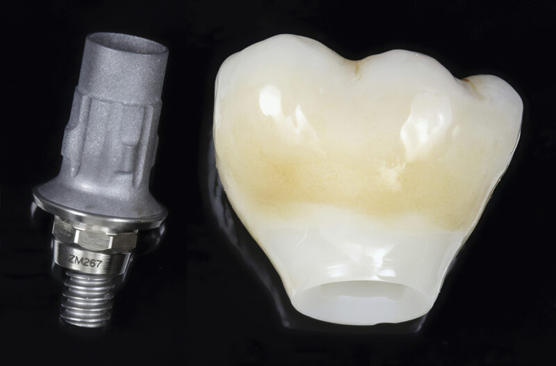 Ti-base abutment and screw-retained crown – precise fit before assembly and placement in the mouth