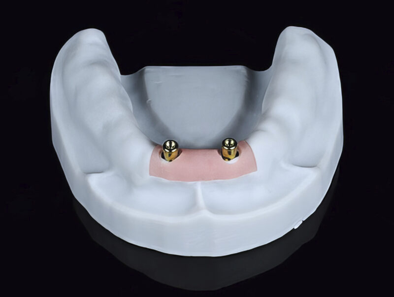 Working model with axial abutments for implant-supported overdenture